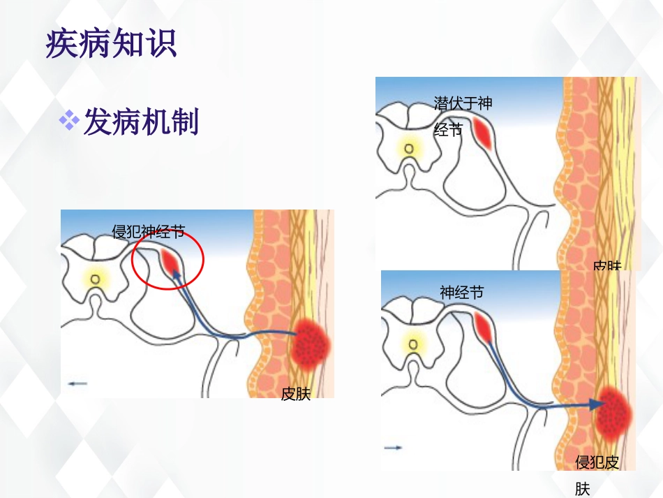 皮肤科-带状疱疹后遗神经痛护理查房_第6页