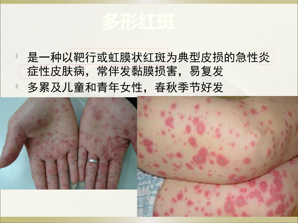 《皮肤病》多形红斑_第3页