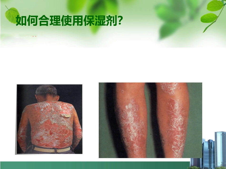 银屑病外用药物治疗与卡泊三醇_第10页