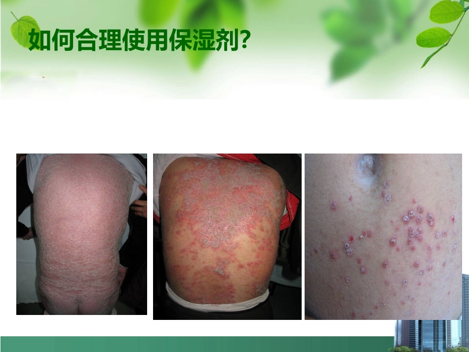 银屑病外用药物治疗与卡泊三醇_第11页