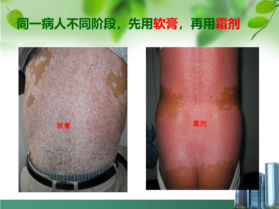 银屑病外用药物治疗与卡泊三醇_第12页