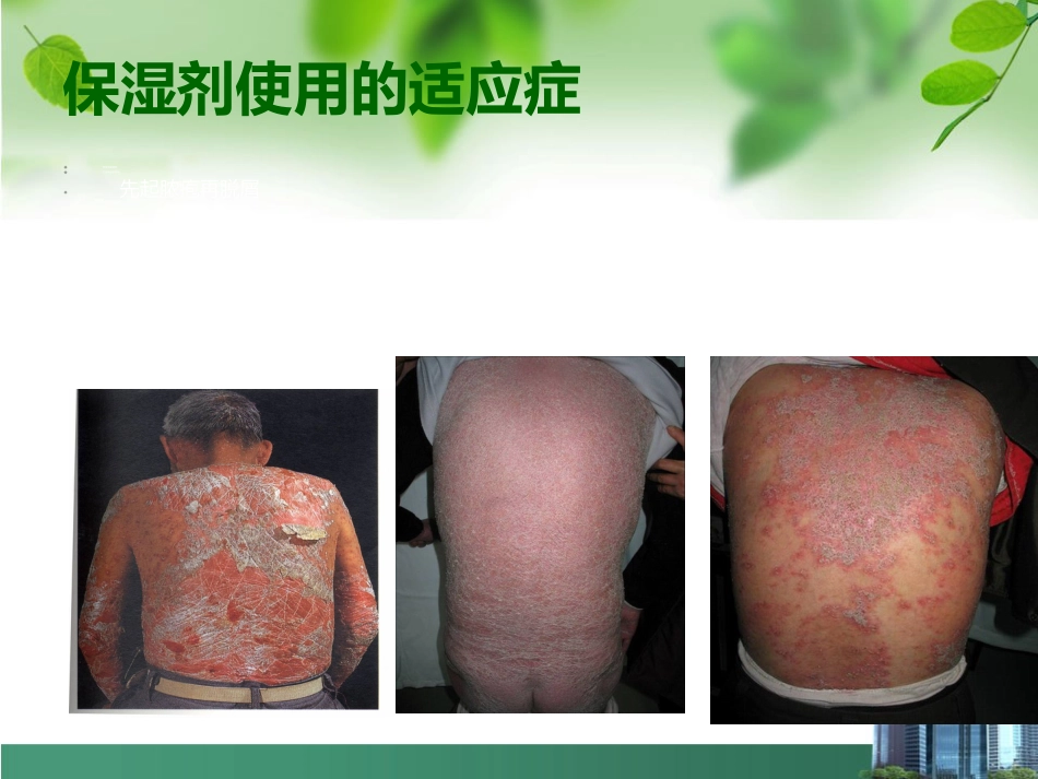 银屑病外用药物治疗与卡泊三醇_第9页