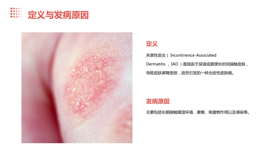 度失禁性皮炎预防及护理ppt课件_第4页