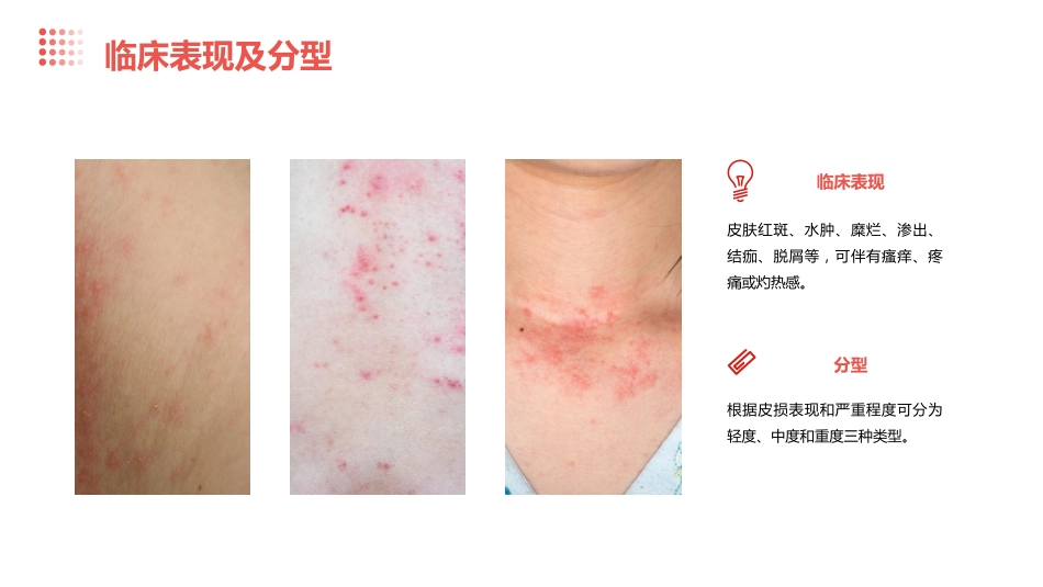 度失禁性皮炎预防及护理ppt课件_第5页