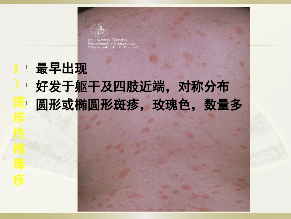《皮肤病》玫瑰糠疹_第11页