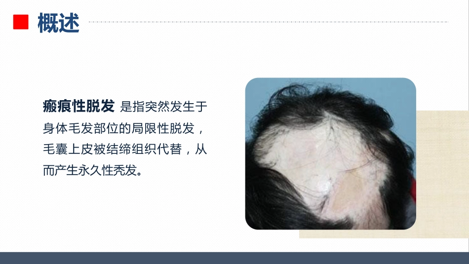皮肤科-瘢痕性脱发患者的护理查房_第4页
