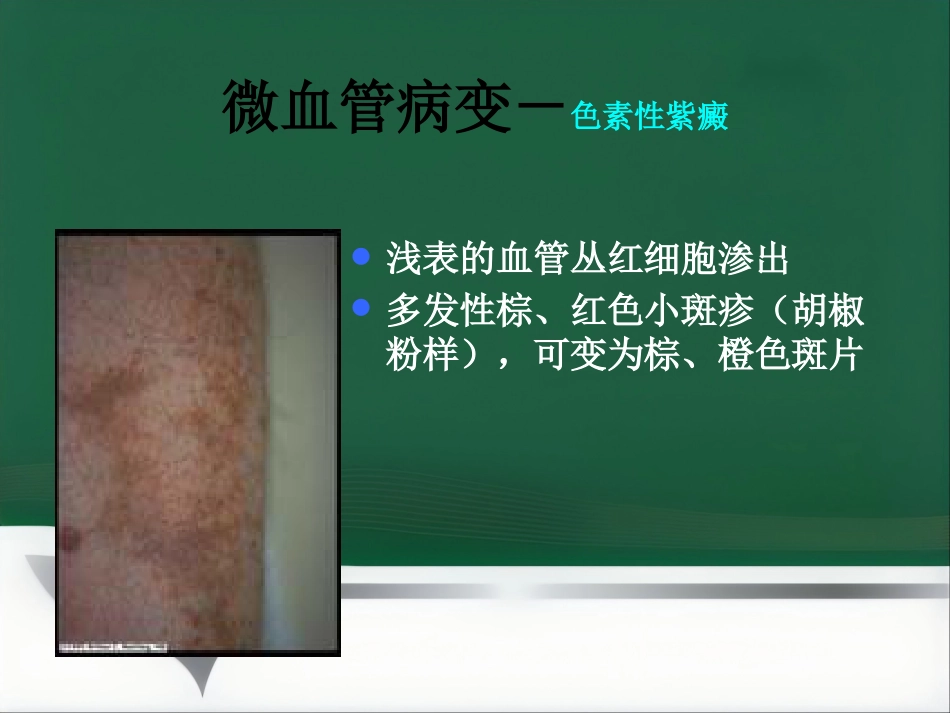 《糖尿病与皮肤病》PPT课件_第14页