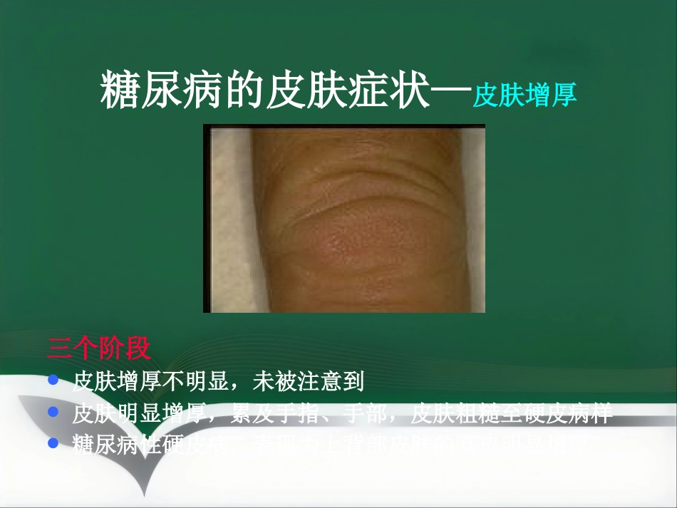 《糖尿病与皮肤病》PPT课件_第5页