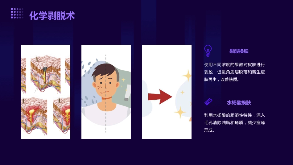 痤疮的治疗ppt课件_第13页