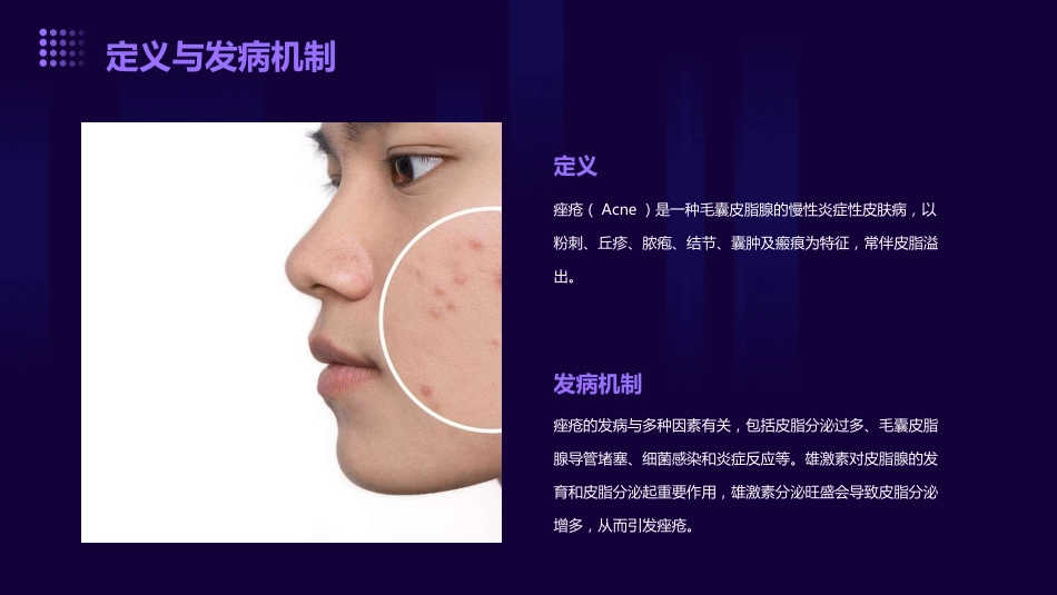 痤疮的治疗ppt课件_第4页
