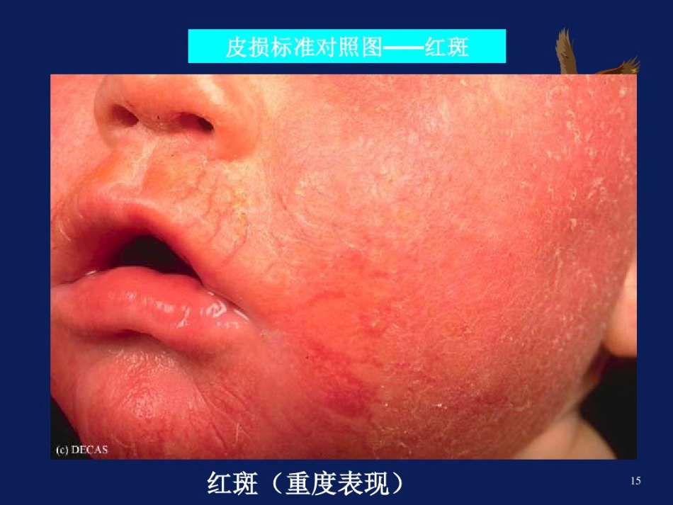 特应性皮炎AD的中西医诊疗进展_第15页