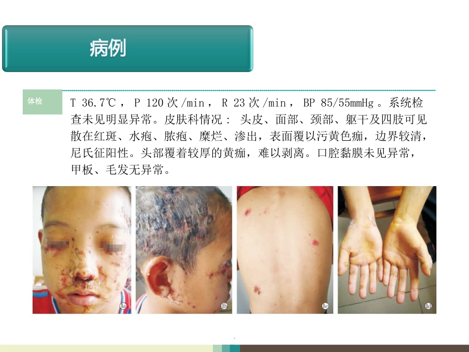 天疱疮病例讨论ppt课件_第3页