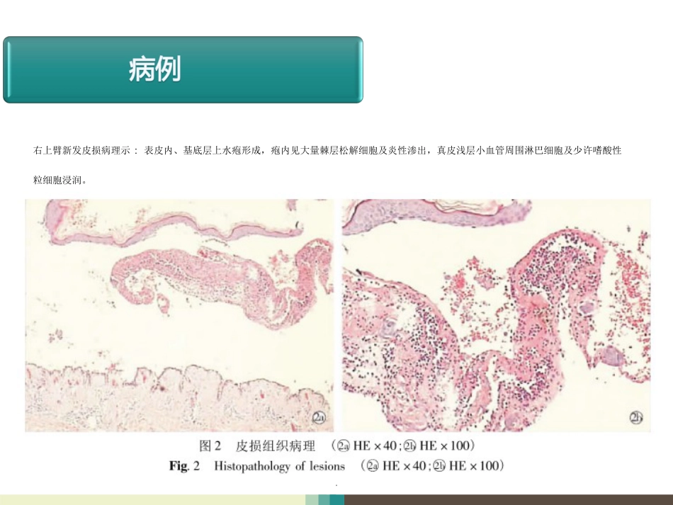 天疱疮病例讨论ppt课件_第5页