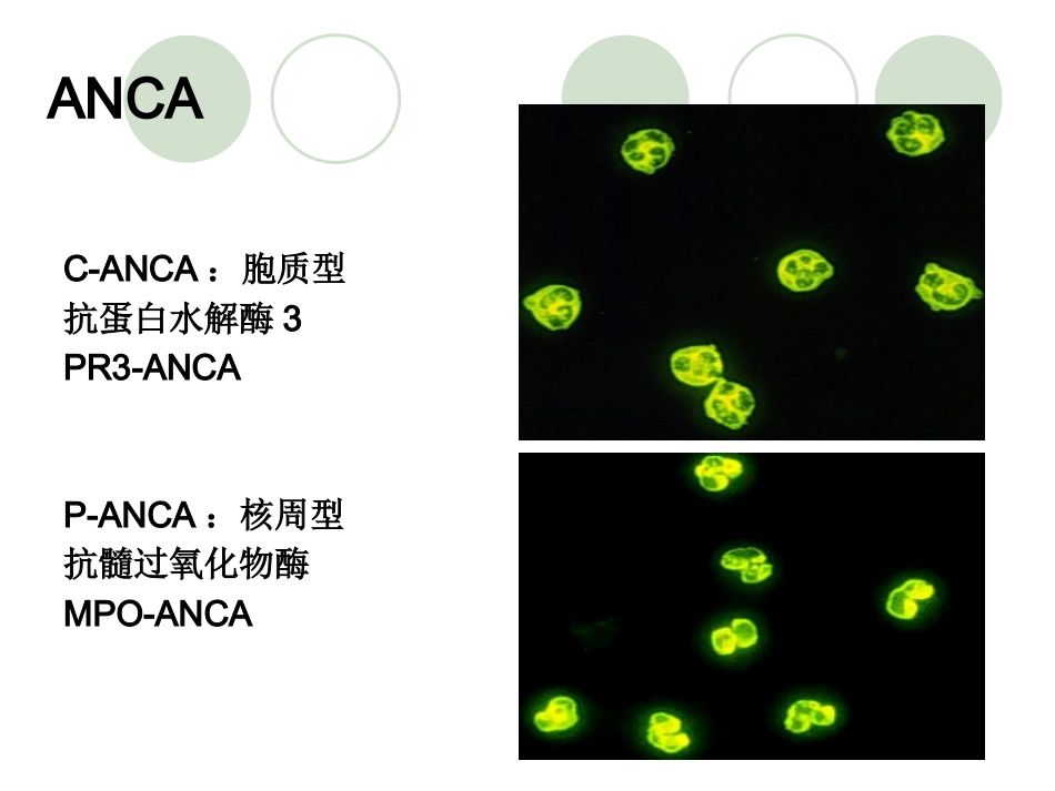 ANCA相关性血管炎医学知识讲解_第10页