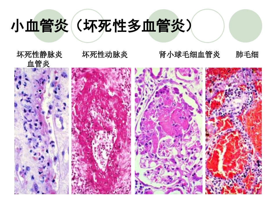 ANCA相关性血管炎医学知识讲解_第4页