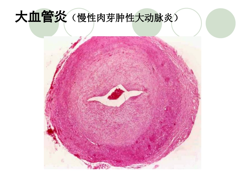 ANCA相关性血管炎医学知识讲解_第5页