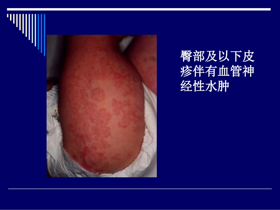 (包含有120种与关节、骨骼、肌肉等相关的疾病) 过敏性紫癜_第13页