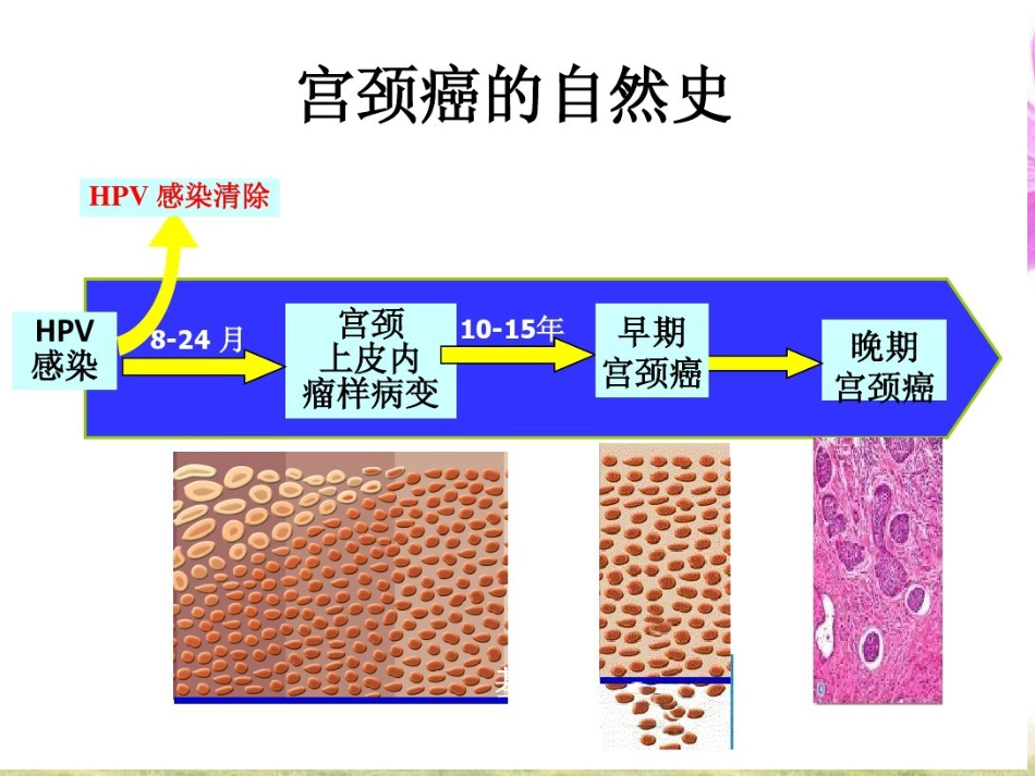 HPV感染与宫颈癌【19页】_第11页