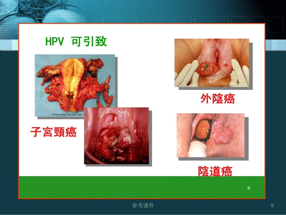 HPV感染与宫颈癌关系【34页】_第9页