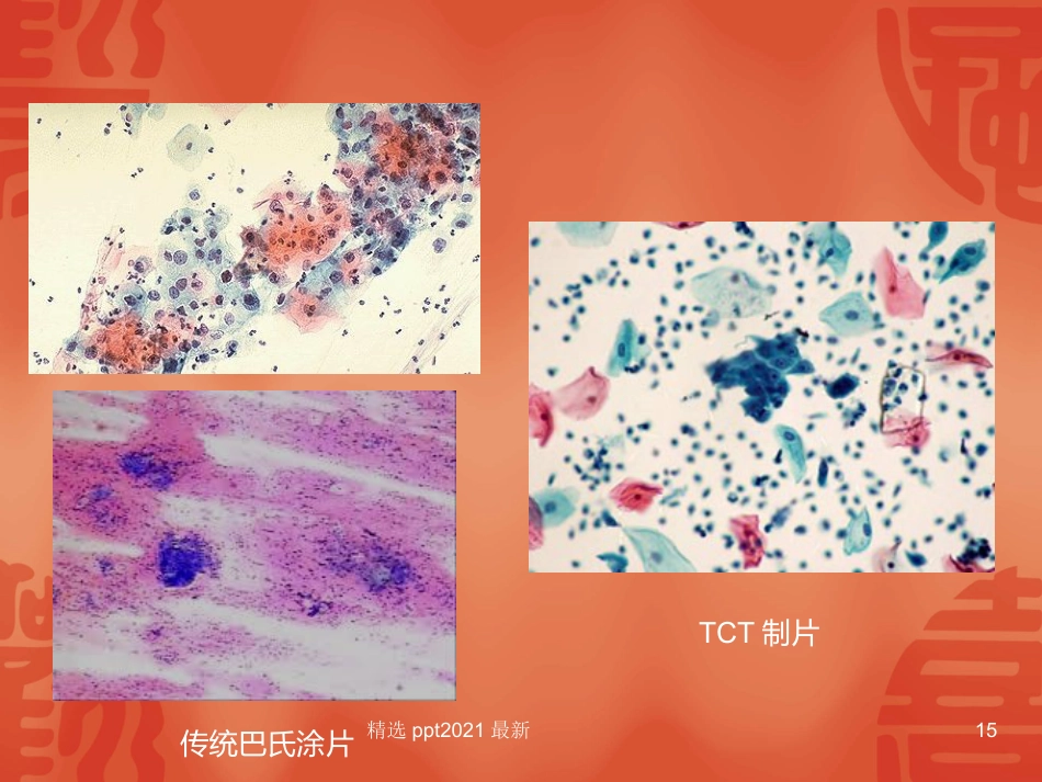 TCT和HPV检测在宫颈癌诊断中的临床应用【34页】_第15页