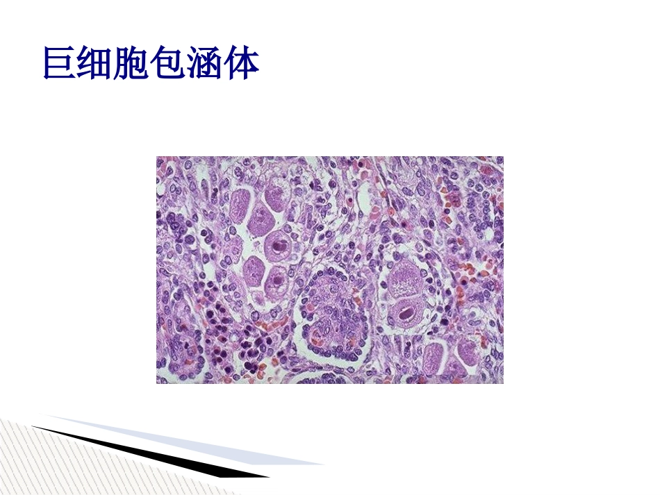 儿童巨细胞病毒性疾病诊断和防治【51页】_第3页