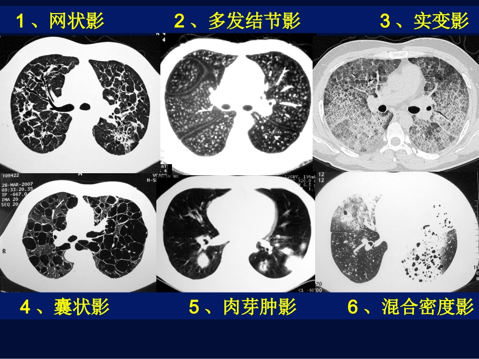 肺孢子虫肺炎与巨细胞病毒肺炎【116页】_第10页