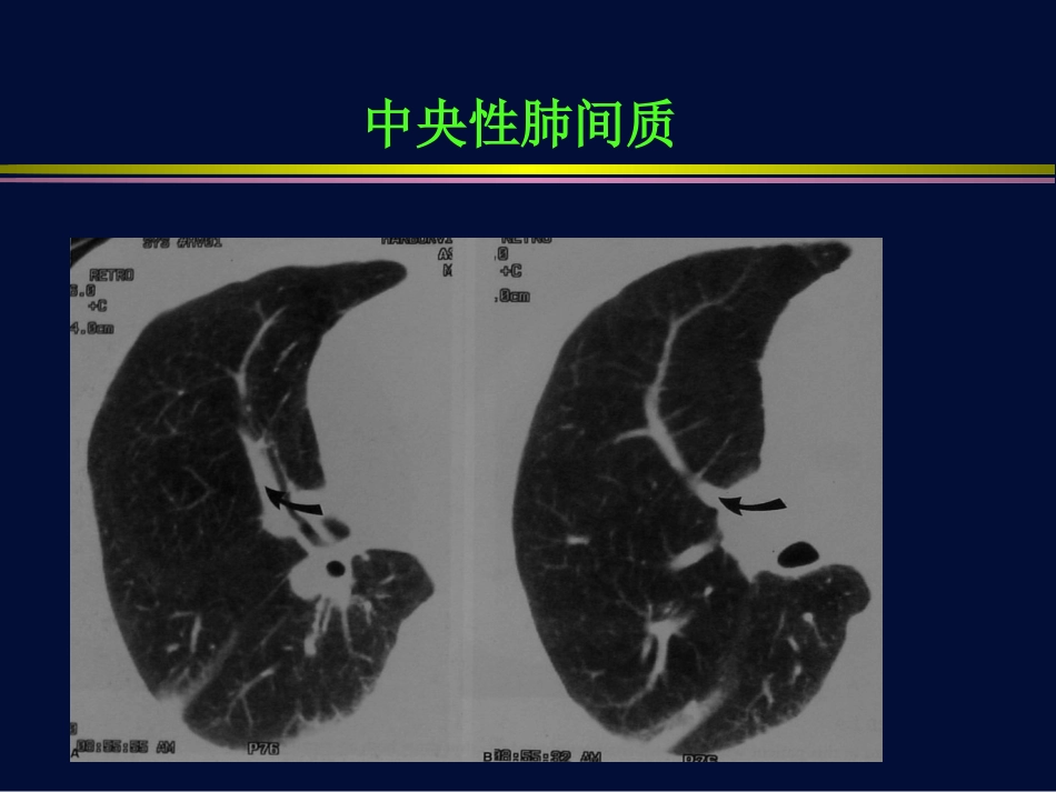 肺孢子虫肺炎与巨细胞病毒肺炎【116页】_第7页
