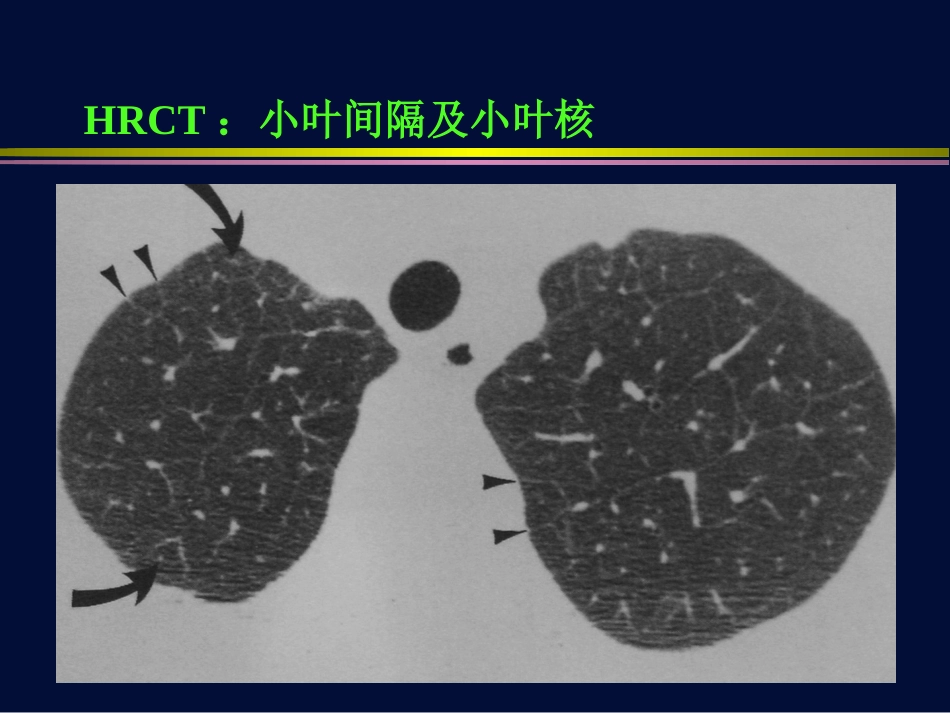肺孢子虫肺炎与巨细胞病毒肺炎【116页】_第8页