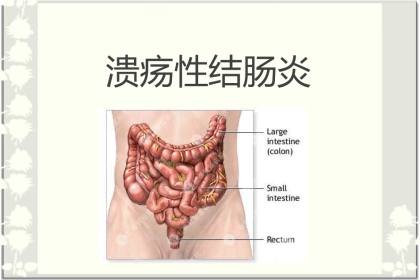 消化内科-溃疡性结肠炎