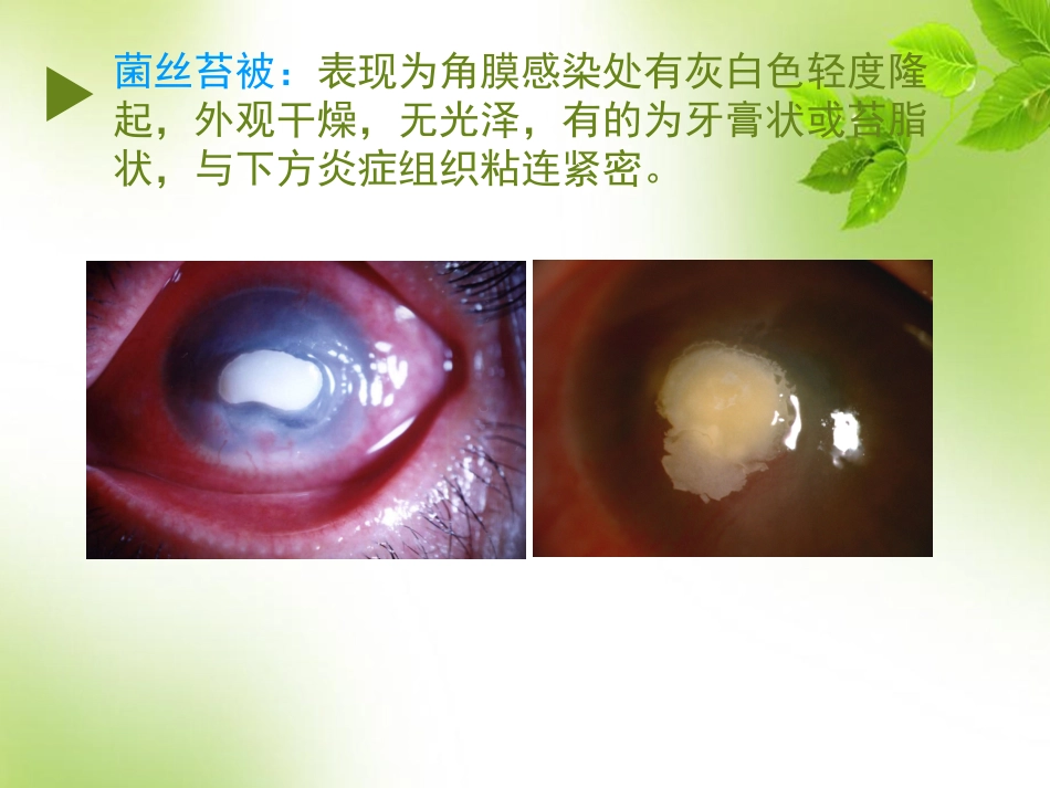 角膜 角膜炎_第14页