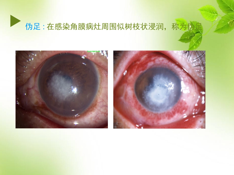 角膜 角膜炎_第15页
