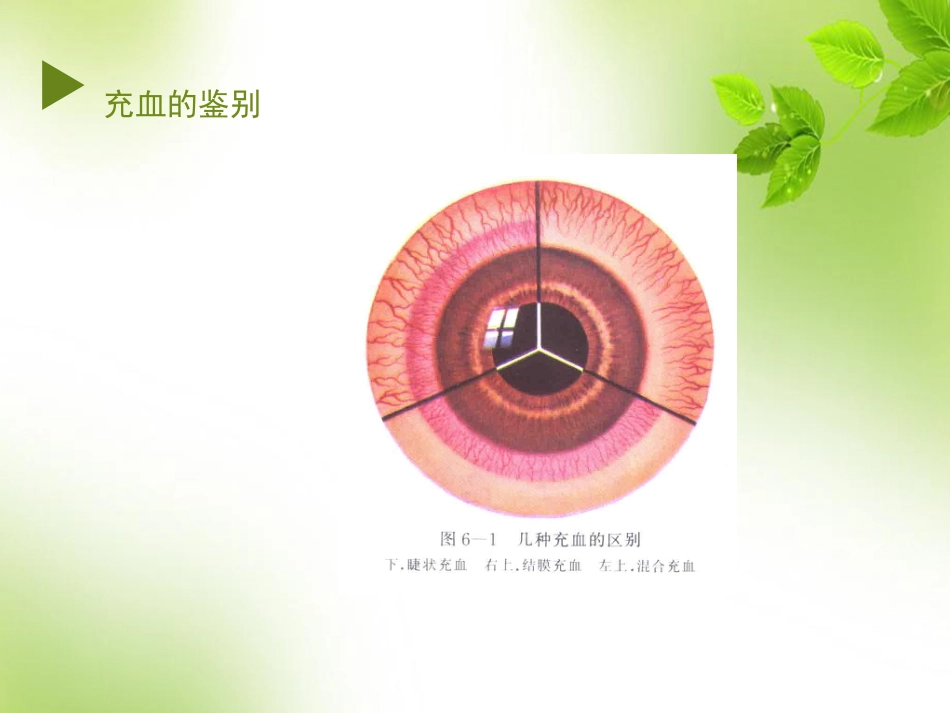 角膜 角膜炎_第7页