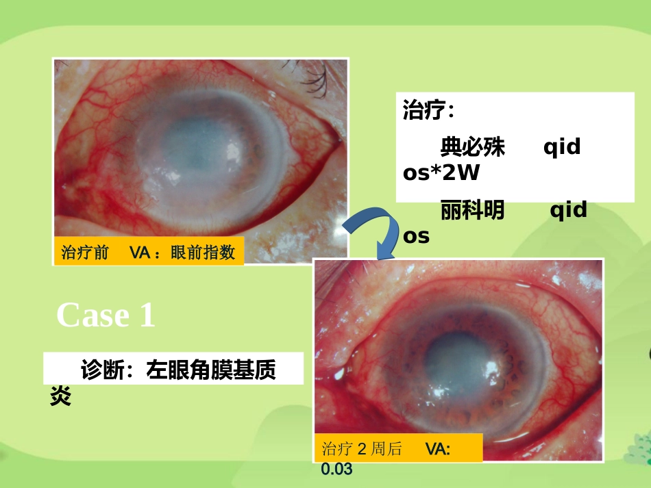 激素在眼表疾病中的使用原则与策略_第13页