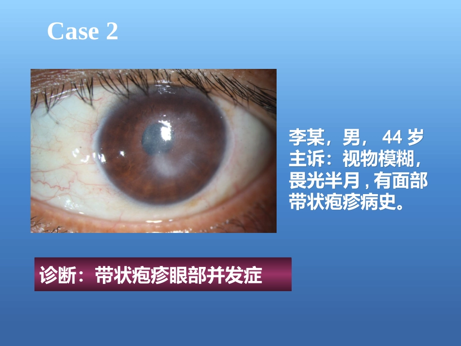 激素在眼表疾病中的使用原则与策略_第14页