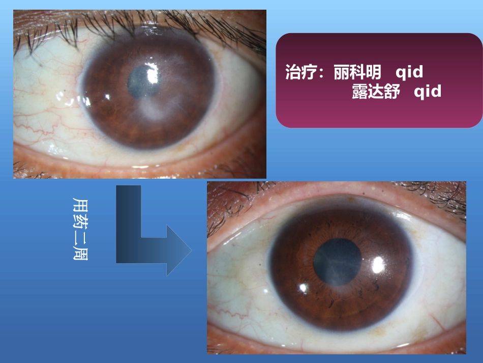 激素在眼表疾病中的使用原则与策略_第15页