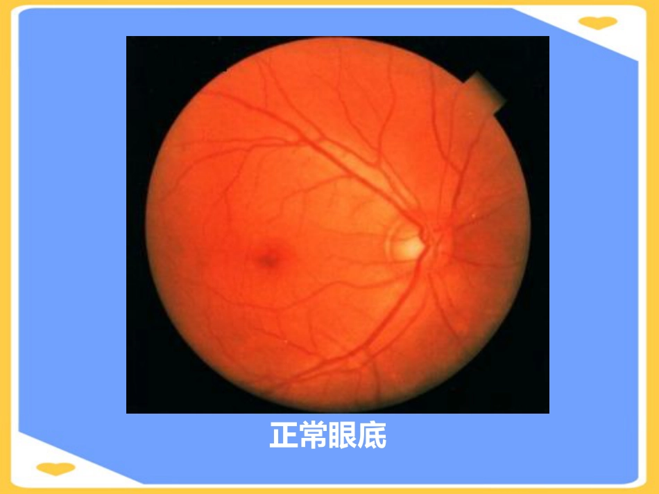 高压氧在眼科的应用PPT_第6页