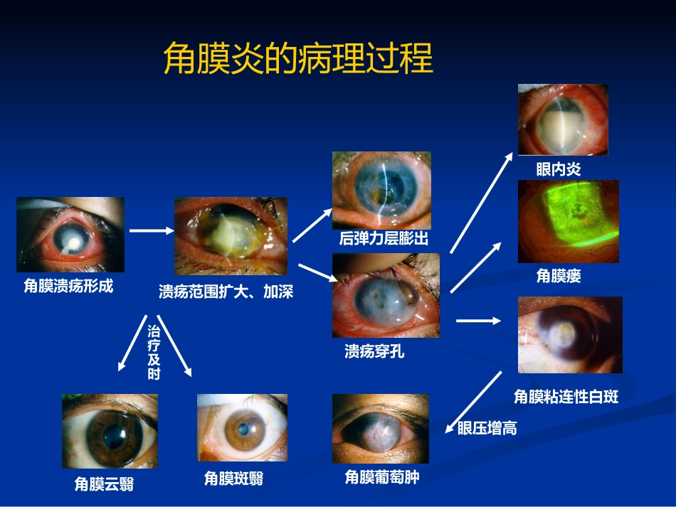 角膜炎_第11页