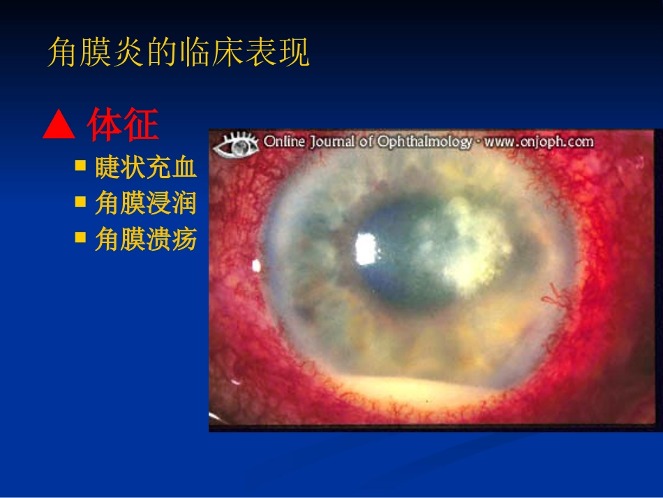 角膜炎_第13页