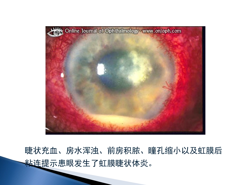 角膜炎-PPt_第11页