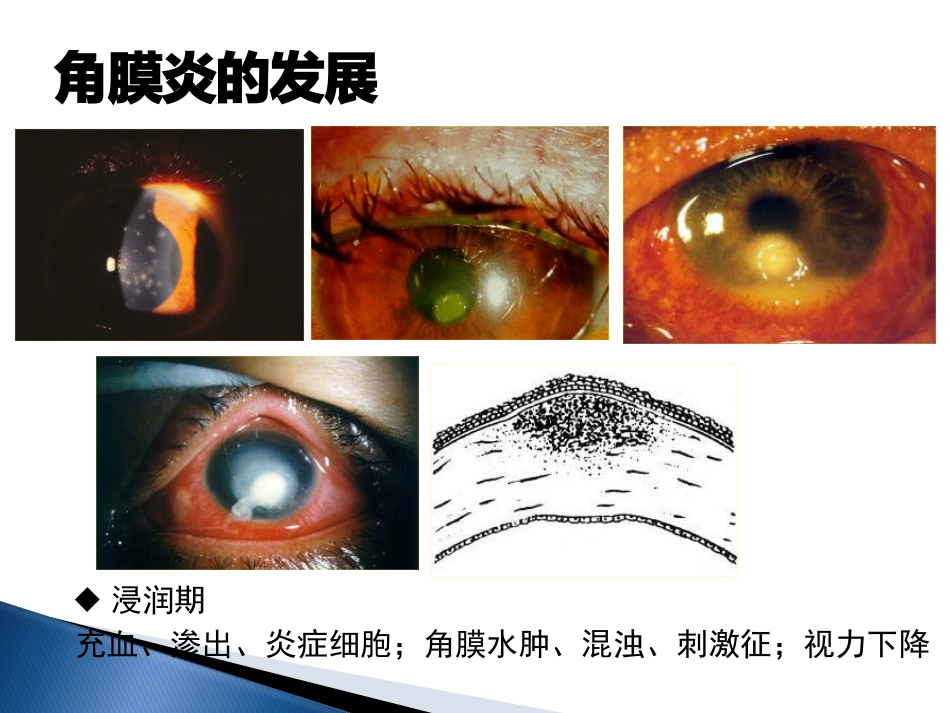 角膜炎-PPt_第5页