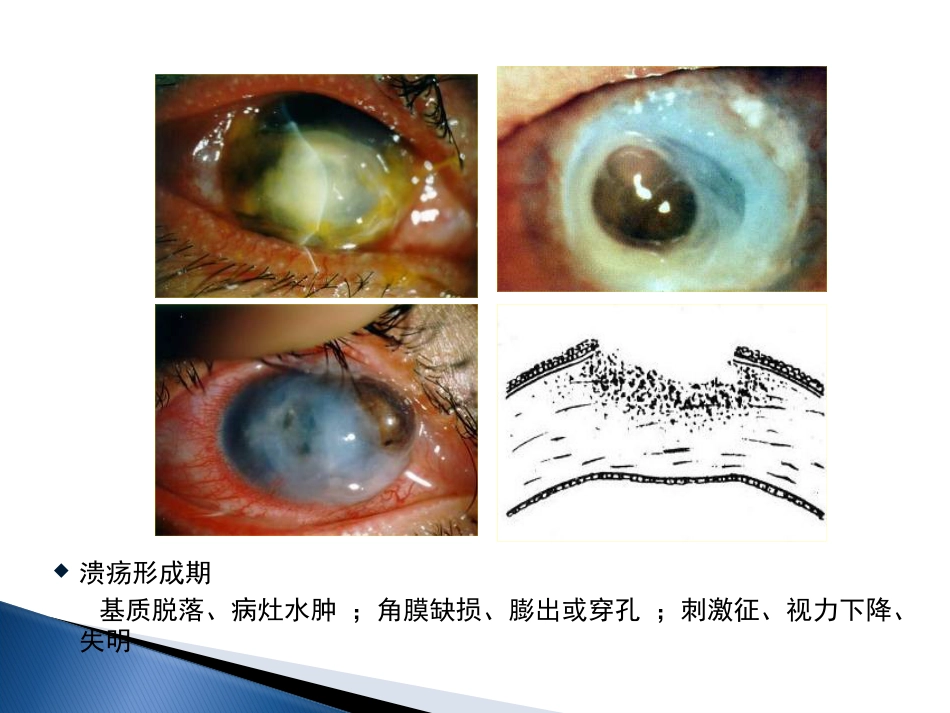 角膜炎-PPt_第6页