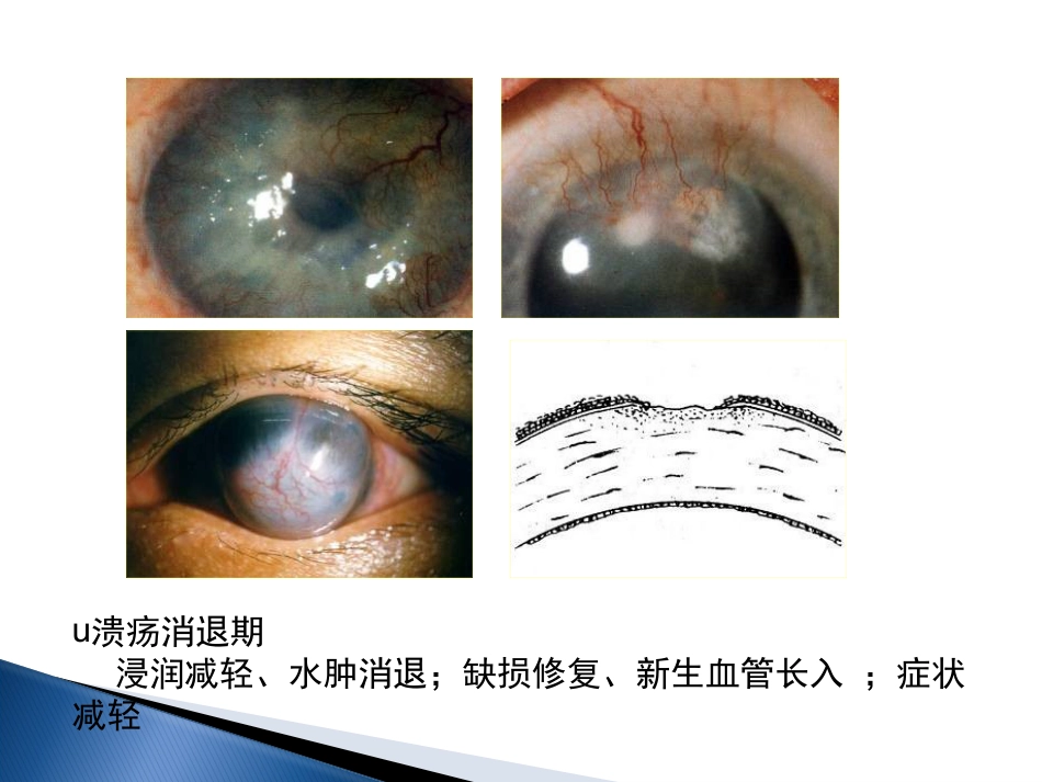 角膜炎-PPt_第7页