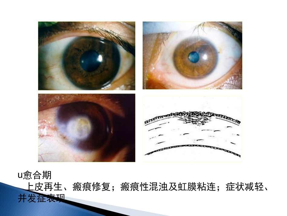 角膜炎-PPt_第8页