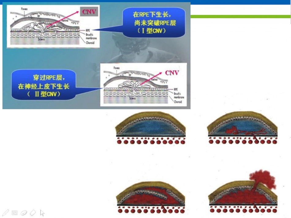 高度近视黄斑新生血管改汇总_第3页