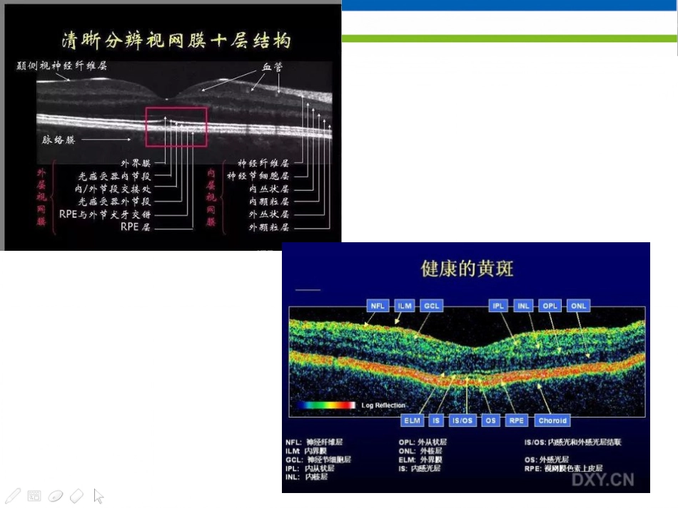 高度近视黄斑新生血管改汇总_第8页