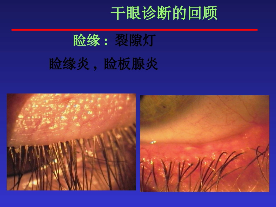 干眼症的防治_第10页