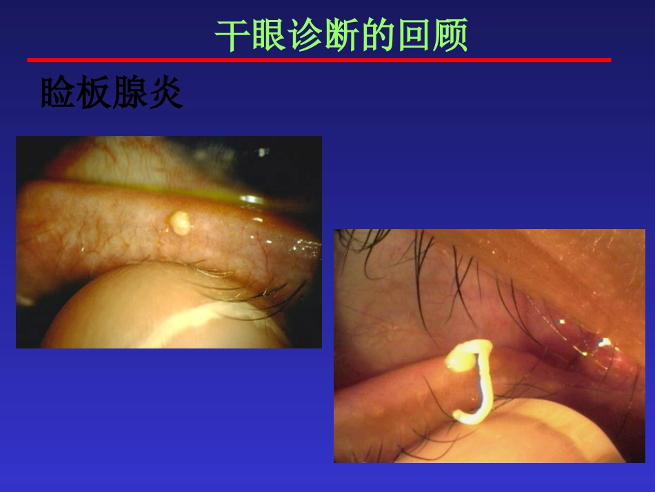 干眼症的防治_第11页