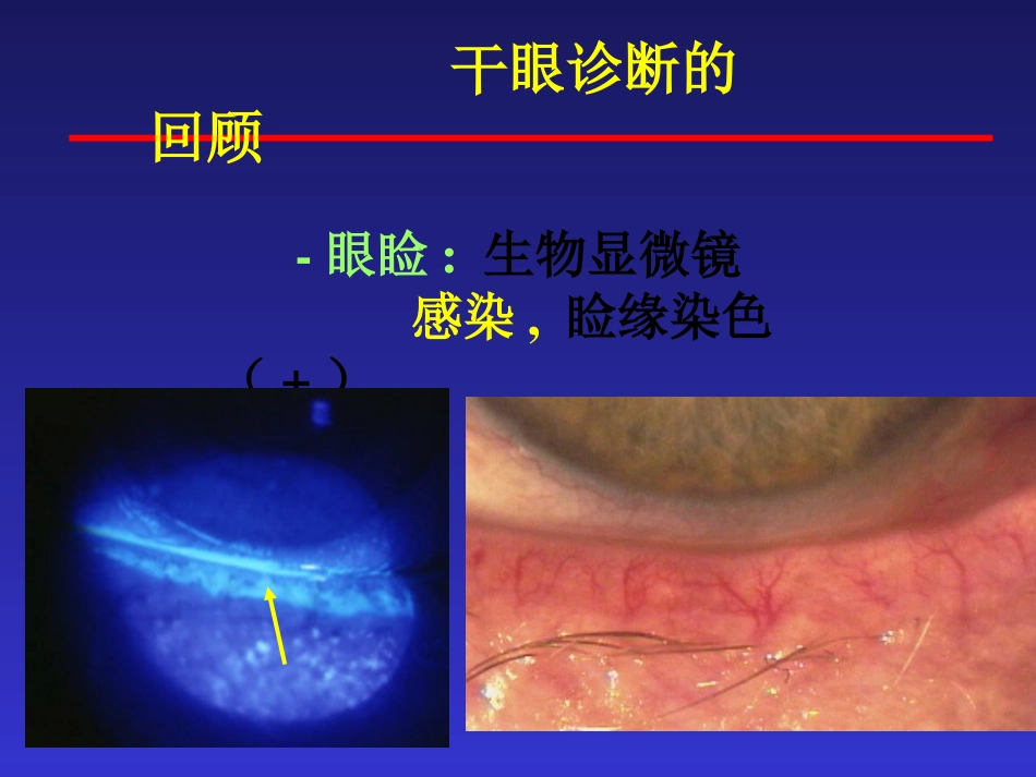干眼症的防治_第15页