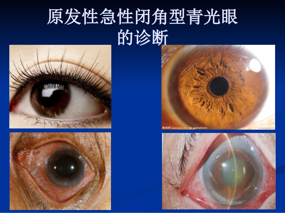 急性闭角型青光眼的诊断与治疗剖析_第13页