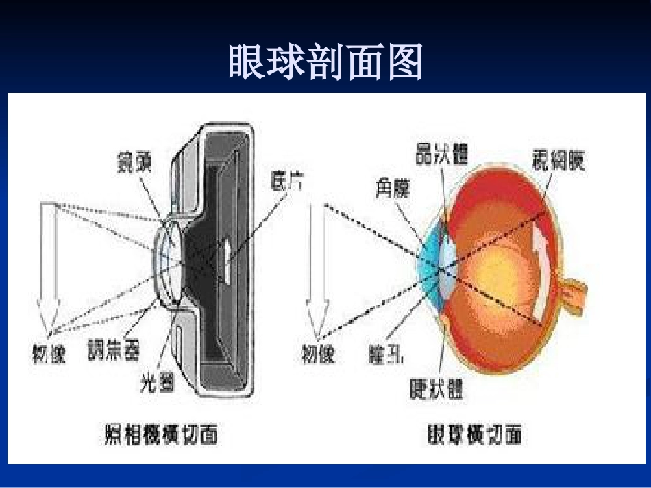 急性闭角型青光眼的诊断与治疗剖析_第2页